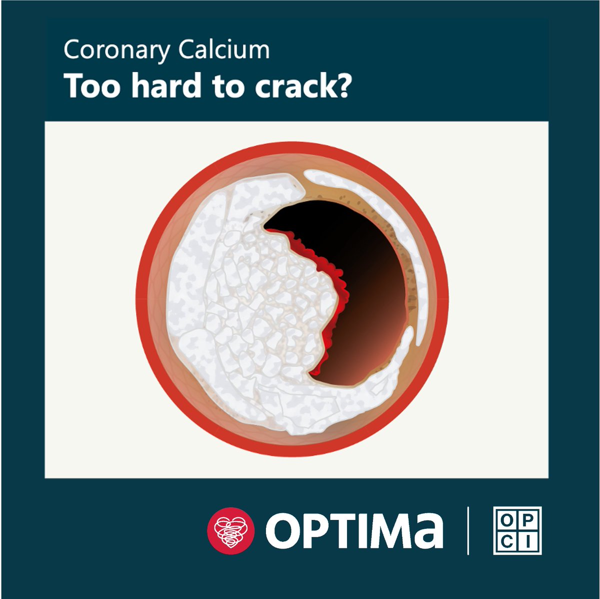 jcspratt's tweet photo. #Optimalpcilondon explores coronary arterial #calcium, how to assess and treat safely.
Two bespoke keynote lectures, two live cases & two hours of interactive learning with simulations, demonstrations, and discussions.
Registration is open join now ➡ https://t.co/iEJOjgjddR https://t.co/5o9REonxby