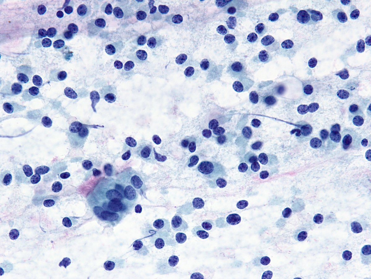 SLAM DUNK dx of “Carcinoid Tumor” on Bronchial Brushing. Diagnosis is easy when you have an in-field comparison with benign bronchial epithelium. Just a gorgeous example.