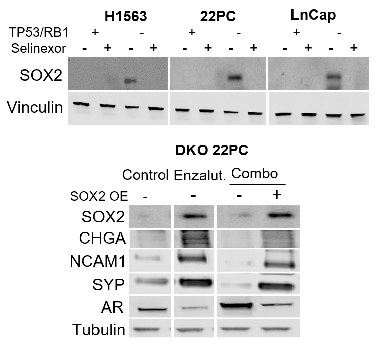 AlvaroQuintanal's tweet photo. SOX2, a key TF for transformation, is induced by TP53/RB1 inactivation, but downregulated by selinexor, thus hindering #lineageplasticity. Indeed, if we ectopically overexpress SOX2, we can rescue the transformation neuroendocrine phenotype. https://t.co/c6i5NZ36Up