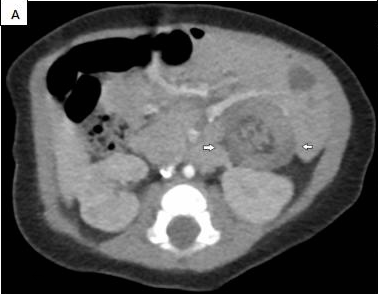 JPGNonline's tweet image. 1 month old girl has fussiness and hematochezia for 2 days.  Imaging shows a colocolic intussusception and possible lead point.

What's the most common lead point for colocolic intussusception in kids?

Answer and learn more 👉 bit.ly/3htf9YP?utm_so…

#imageofthemonth #quickpoll
