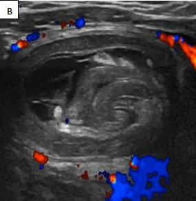 JPGNonline's tweet image. 1 month old girl has fussiness and hematochezia for 2 days.  Imaging shows a colocolic intussusception and possible lead point.

What's the most common lead point for colocolic intussusception in kids?

Answer and learn more 👉 bit.ly/3htf9YP?utm_so…

#imageofthemonth #quickpoll