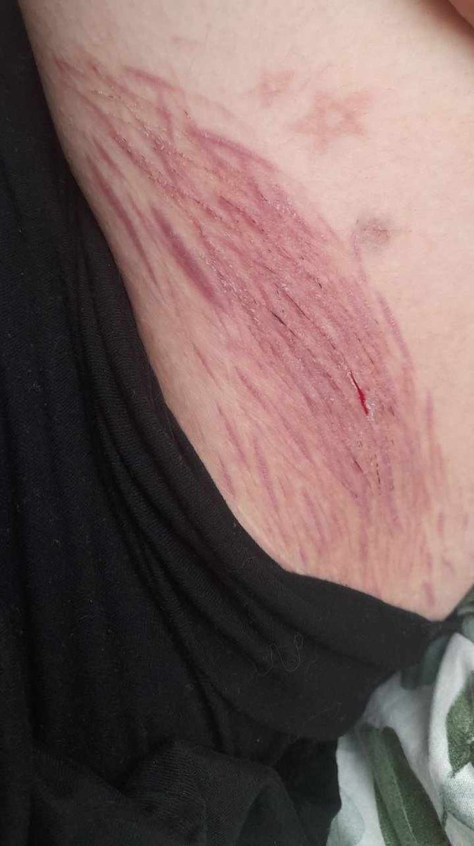 _an3m0n3's tweet photo. scars https://t.co/nfC4vELMWL