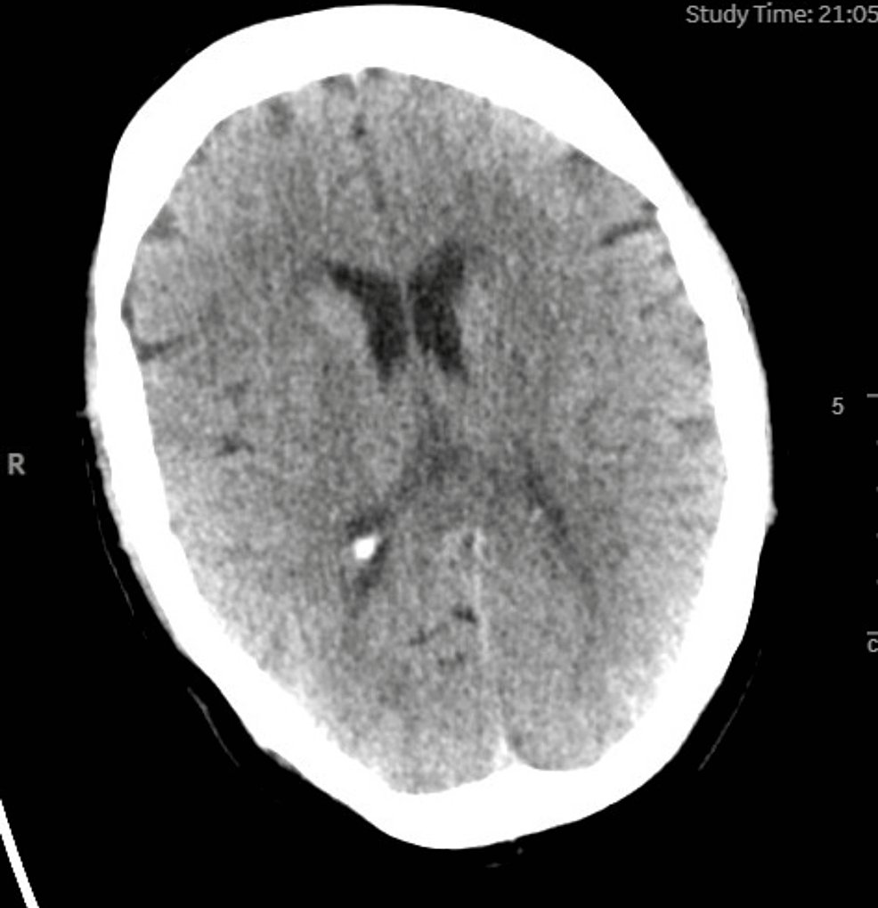 Grayson Wheatley (@drwheatley) on Twitter photo A Case of Acute Aortic Dissection Presenting With Neurological Symptoms
cureus.com/articles/17316… A Case of Acute Aortic Dissection Presenting With Neurological Symptoms
cureus.com/articles/17316…