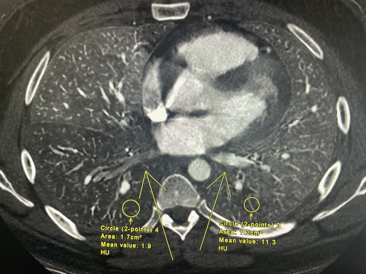 Giovanni_Lorenz's tweet image. does show a iodine map perfusion defect and hypoperfusion of the right infer pulmonary vein (postcapillary). Patient went on to #firstecho and #whycmri showing gradient abnormalities in the RIPV…likely thrombus in the vein.