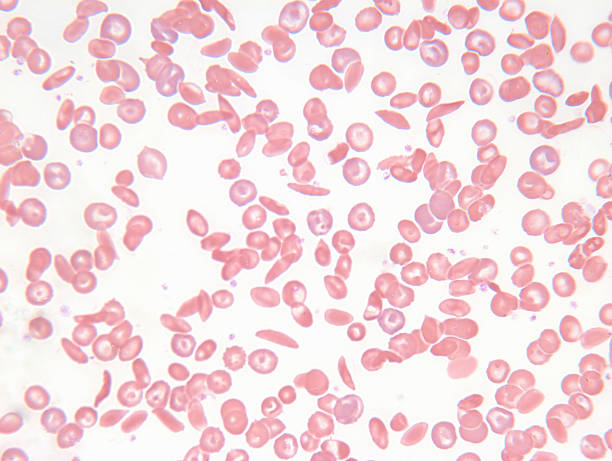 ophth_advisor's tweet photo. #ASRS2023: OCT-A may identify #MicrovascularChanges in pediatric patients with #SickleCellRetinopathy.
Presented at the @asrsdocs Annual Meeting by @HoyekSandra, MD of @harvardmed & @MassEyeAndEar
https://t.co/Af0wOk98Eo
#SickleCellDisease #Ophthalmology #MedTwitter https://t.co/DcLfR7dSaP