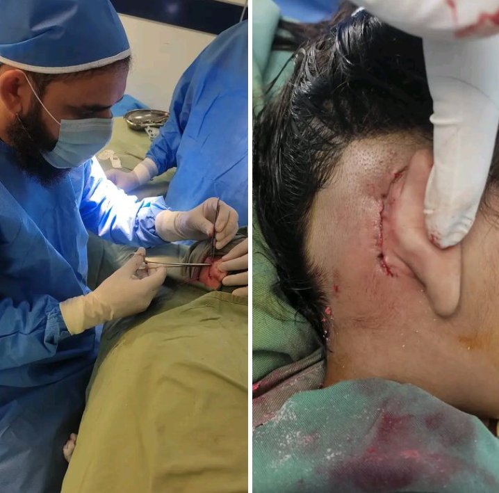 د ؤطن ډاکټر💪
ډاکټر نجیب الرحمن حنیف:
نن مو د ۷ کاڼو ماشومانو غؤږونو عصبي سیستم چې د دماغو سره د مصنوعي آلې لۀ لارې ؤصل کيږي (پۀ غوږ کې لۀ حرکت لؤېدلي ؤړوکي هډوکي لرې کؤل اؤ پر ځای یې مصنوعي هډوکي اچؤل) عملیات ؤکړل.
پۀ داسې کلیؤال/ ګاؤنډي ؤیاړم.
عصري علوم❤