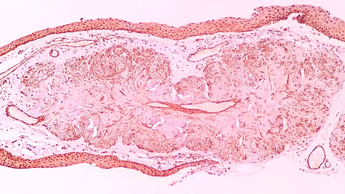 Angioleiomioma conjuntival:
🔸Uno de los tumores +raros en 👁️(+95% de leiomiomas en tracto genital♀️).
🔸Benigno, puede degenerar⚠️.
🔸Origen: M.liso o pericitos de vasos sanguíneos.
🔸🔬: Proliferación fusocelular circunscrita de bajo grado+ hialinización.
🔸#IHCPath+ actina