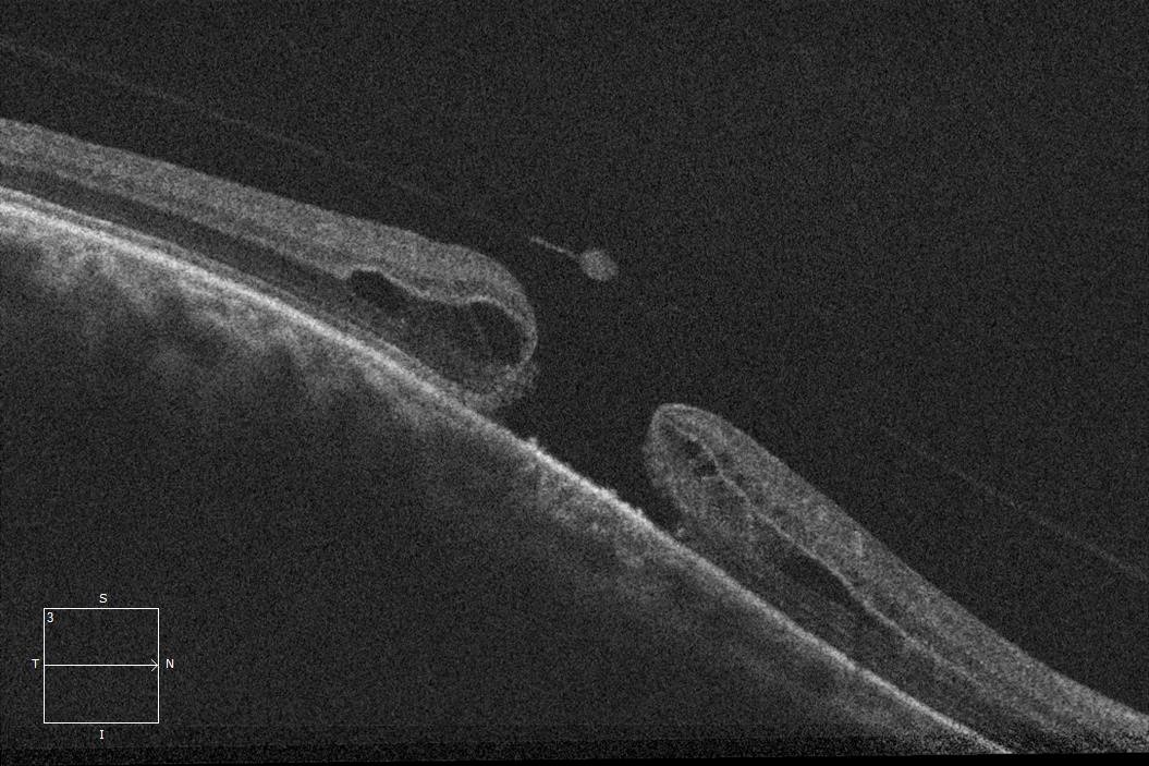 RetinaSERV's tweet photo. DIAGNOSTICO🔬: Agujero Macular

Agujero macular completo con hialoides desprendida y presencia de opérculo👁️🗨️ https://t.co/AwuisvrGNQ