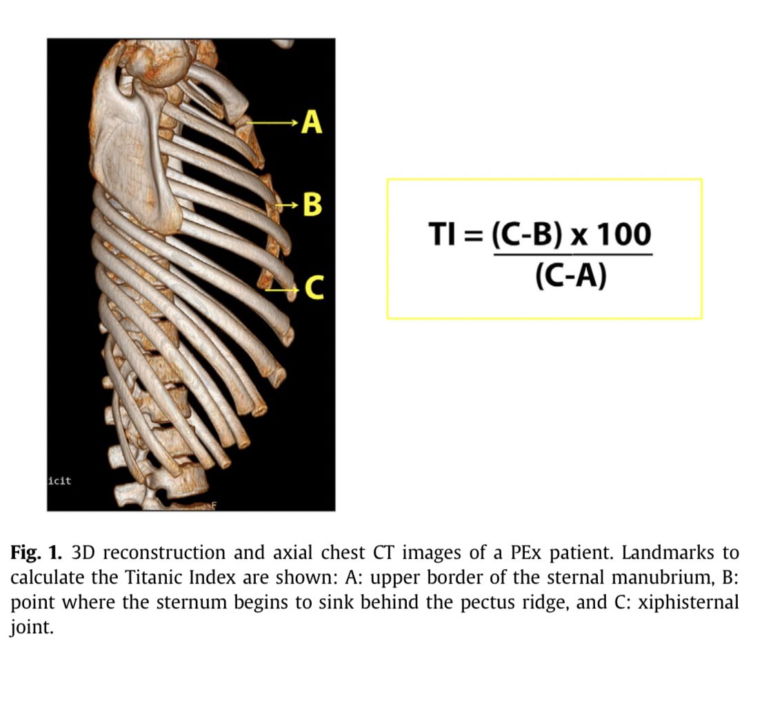 FRANCOAGUSTIN88's tweet image. La cuantificación de gravedad de las deformidades del pectus excavatum se realiza utilizando el índice de Haller (HI) y el índice de corrección (IC)
Índice TITANIC 🚢podría ser útil para planificar el número de implantes necesarios para la remodelación torácica 🛳️

#SoMe4PedSurg