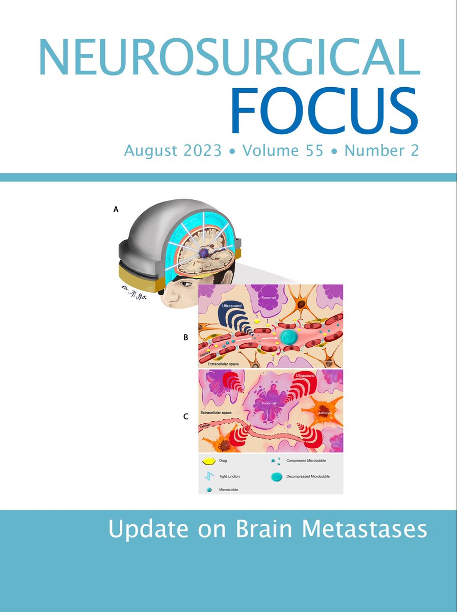 JamesRutka's tweet photo. Everything you ever wanted to know about the management of brain metastases, and more! Now in latest issue of NS Focus for @TheJNS ! https://t.co/ZSmENdMJD0 https://t.co/nVS4PBOsbK