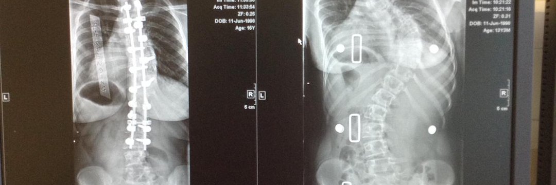 The #PowerofRunning 🏃‍♂️

There's so much to the story, and it begins in 2011, when I had a #spinalfusion to correct #scoliosis. 

A thread 👇
#ukrunchat #running