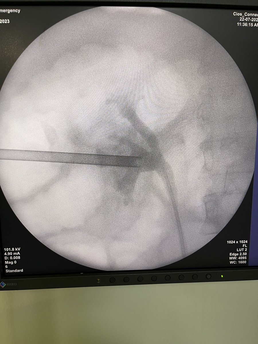 #UroSoMe I❤️mPCNL  Cloudy Colon