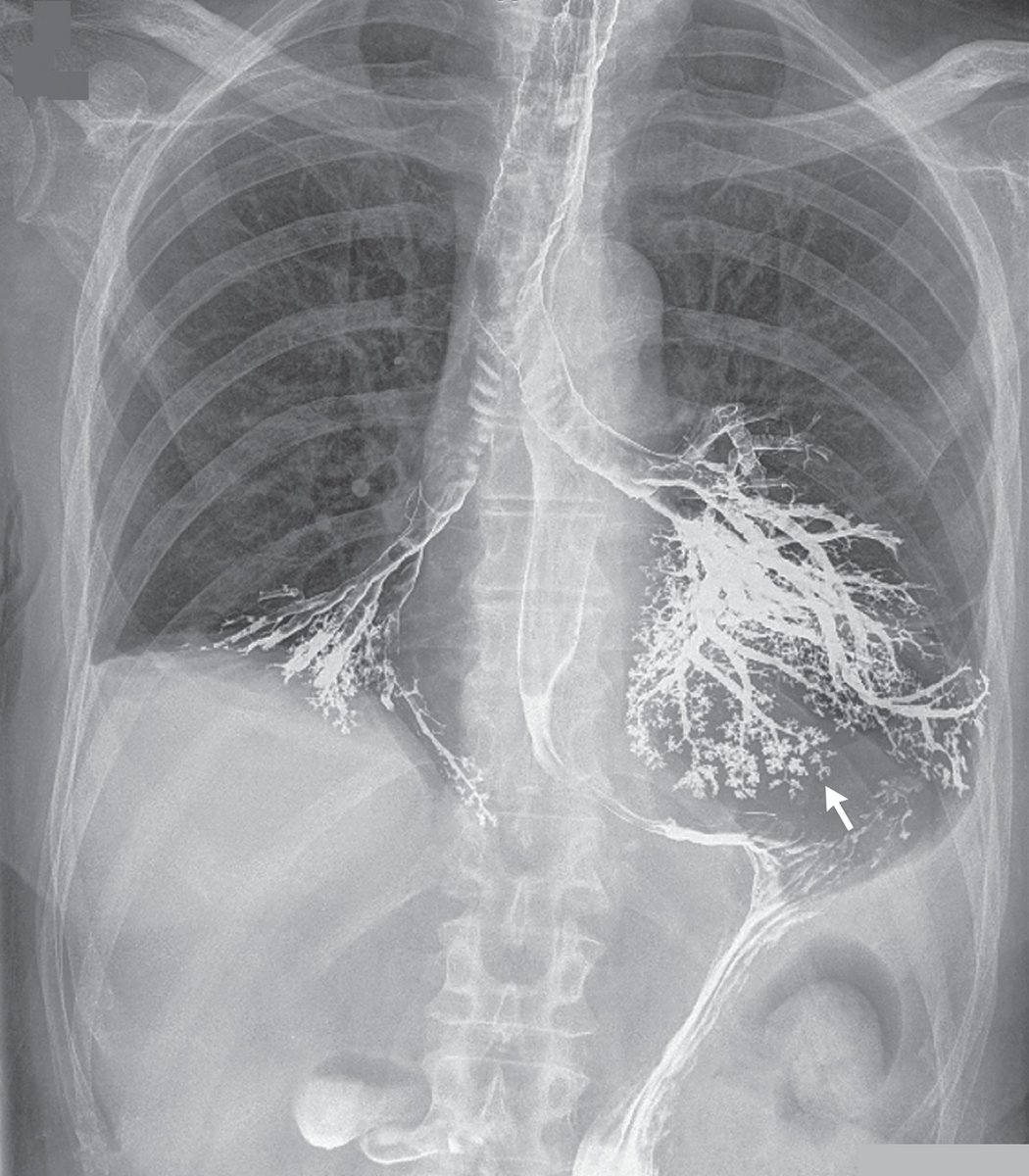Imágenes impresionantes que no te gustaría ver: aspiración por Bario.
Referencia: N Engl J Med 2012; 366:1038
