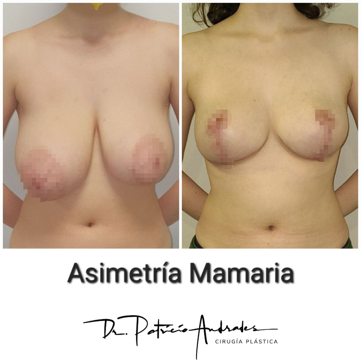 Todas las mujeres tienen sus mamas distintas. Pero cuando esta diferencia es muy notoria puede traer serios problemas para la vida diaria y la autoestima.  Su corrección es una de las cirugías mamarias más difíciles, ya que lograr la simetría perfecta es prácticamente imposible.