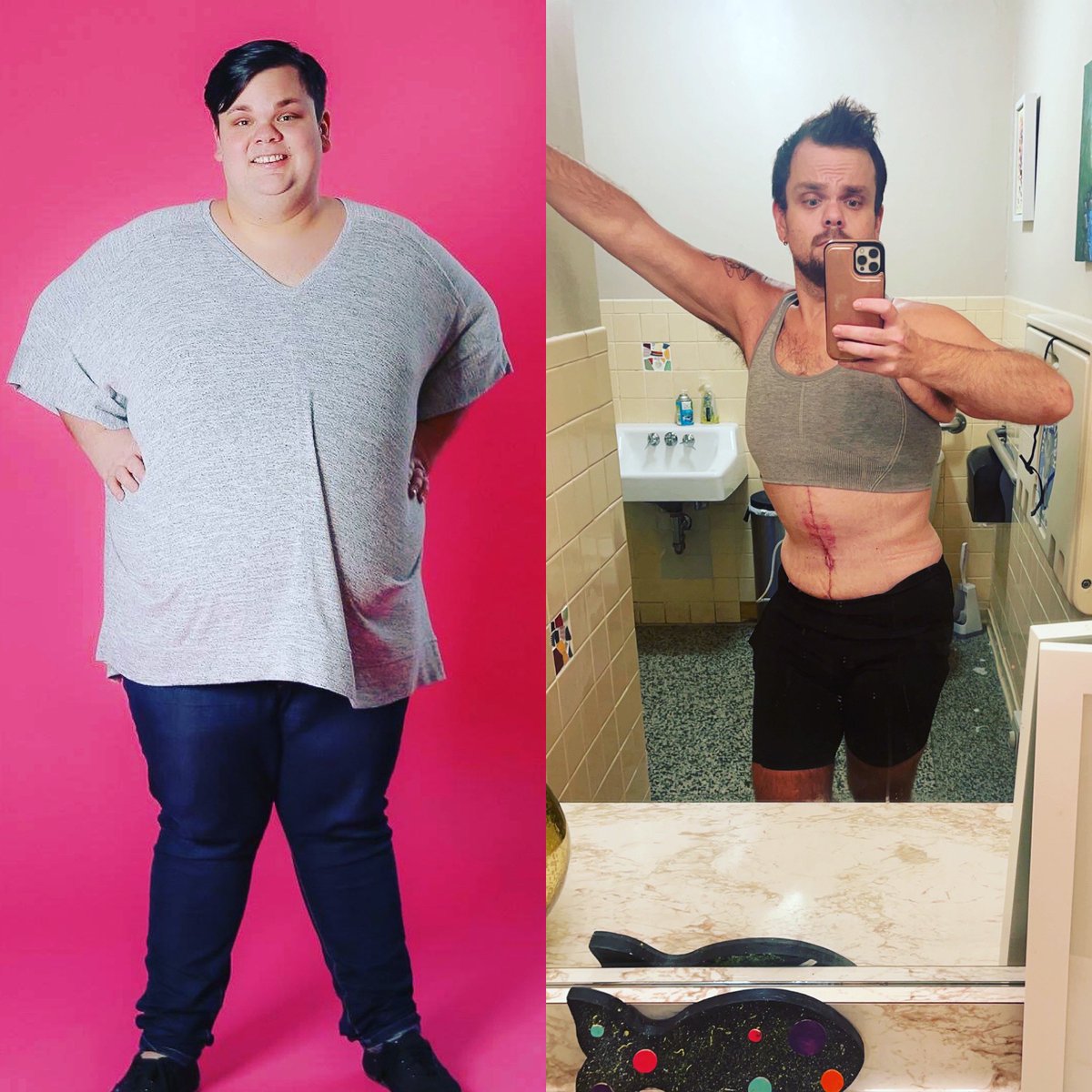 betterishtweets's tweet photo. Two weeks post tummy tuck.

#gay #sober #recovery #weightloss #healthandwellness https://t.co/CO6q6aJ2Fy