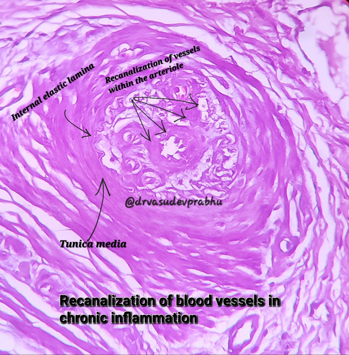 Recanalization of arterioles within an arteriole 🔬💥in chronic inflammation 

Note the firbrosis around the blood vessel and the prominent internal elastic lamina 🔬✌️🤓 #PathTwitter #medtwitter #pathologyresident #pathology  #histopathology #histology