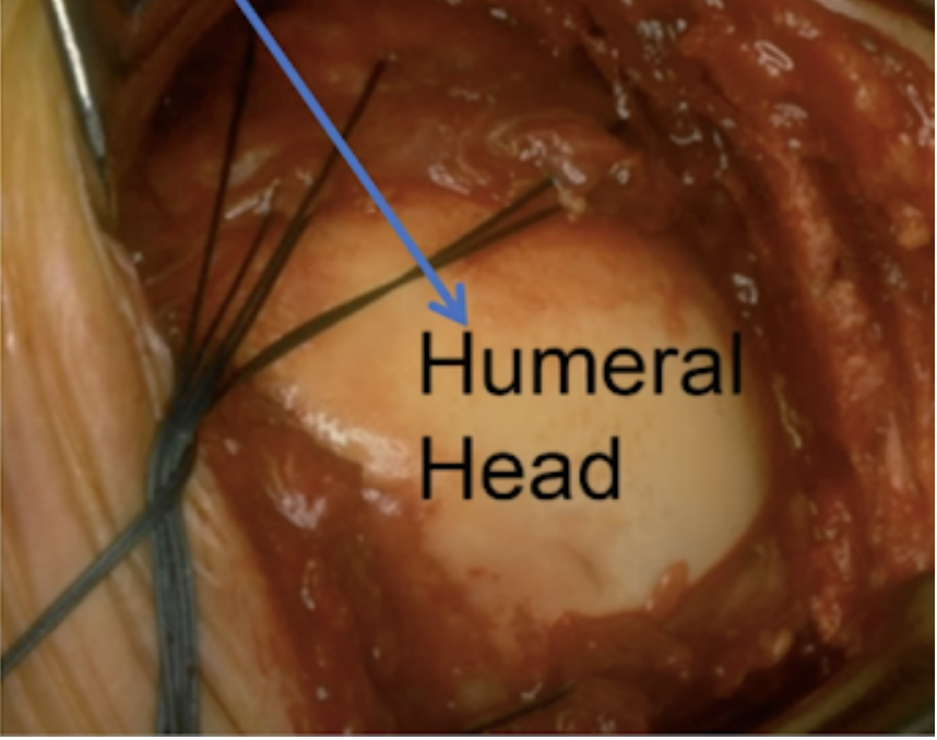 Chronic irreparable rotator cuff tears. shoulderarthritis.blogspot.com/2023/08/massiv…