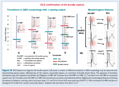 EHRAPresident's tweet photo. #EHRAtopicweek on CSP
#EHRA_ESC Consensus document offers detailed ECG algorithms for HBP &amp; LBBP capture confirmation
✨ Check @Marek_Jastrz_EP study on V6-V1 interpeak interval &amp; @MargaridaPujol stepwise ECG application for more
https://t.co/ah018kSwDy &amp; https://t.co/2ZFQb4DcHq https://t.co/6i0WysOILs