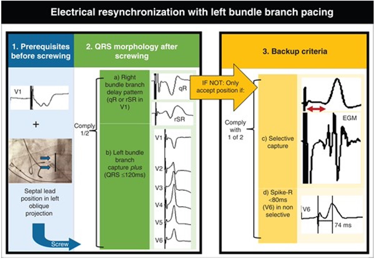 EHRAPresident's tweet photo. #EHRAtopicweek on CSP
#EHRA_ESC Consensus document offers detailed ECG algorithms for HBP &amp; LBBP capture confirmation
✨ Check @Marek_Jastrz_EP study on V6-V1 interpeak interval &amp; @MargaridaPujol stepwise ECG application for more
https://t.co/ah018kSwDy &amp; https://t.co/2ZFQb4DcHq https://t.co/6i0WysOILs
