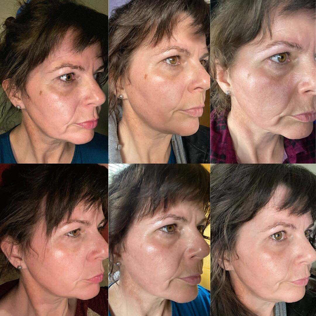 StopGuessingSC's tweet image. If you have dark spots, this is EXACTLY what removes them - Terry

BioFormula Select Review - Stop Guessing Dark Spot Removal

#DarkSpotRemoval #RadiantSkin #ClearComplexion #SkincareEssentials  #bioformulaselect #stopguessingskincare #darkspottreatment #bioformulaselectreview