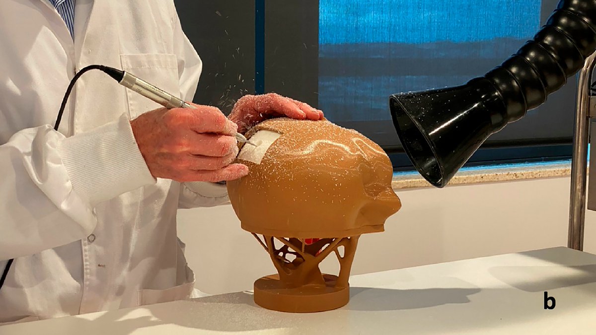 We've identified the best #3Dprinting  materials and settings to represent the #skull 💀, with full results published in World Neurosurgery: "Evaluation of 3D Printed Burr Hole Simulation Models Using 8 Different Materials" doi.org/10.1016/j.wneu…

#3dprint #medtech #Neurosurgery