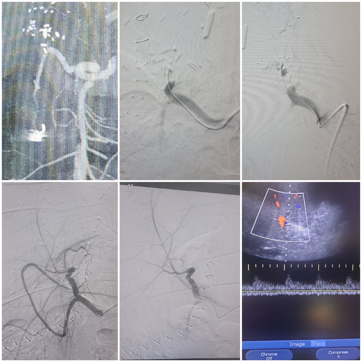Dr Saurabh kumar Interventional radiologist tweet media
