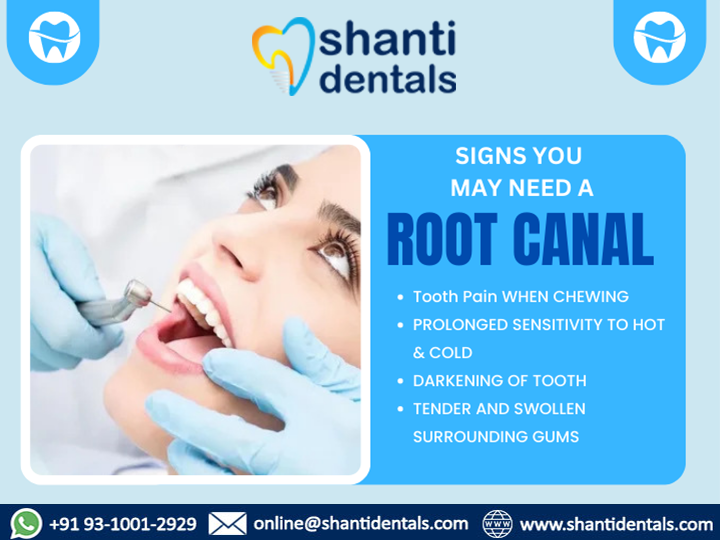 #RootCanalTreatment #RCT is a dental procedure used to treat a severely #infected or #damagedtooth Visit Us: shantidentals.com

#Friday #fridaythoughts #Fridaymorning #Frdaynight #toothpain #Chewing #Sensitivity #SwollenTeeth #Gums #Gumdisease #Gumproblem #Gumtreatment