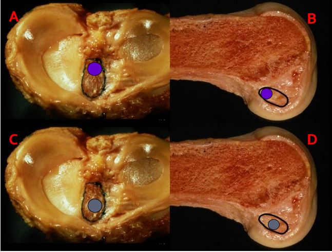 ACL Friday!
Where do you place your tunnels for an ACL reconstruction? A&amp;B? C&amp;D? Other? #orthotwitter #ACLFriday