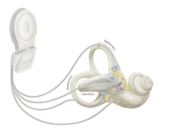 Thanks to medical illustrator Ruoning Qin, we could include this beautiful illustration of an ‘implanted’ vestibular + cochlear implant!