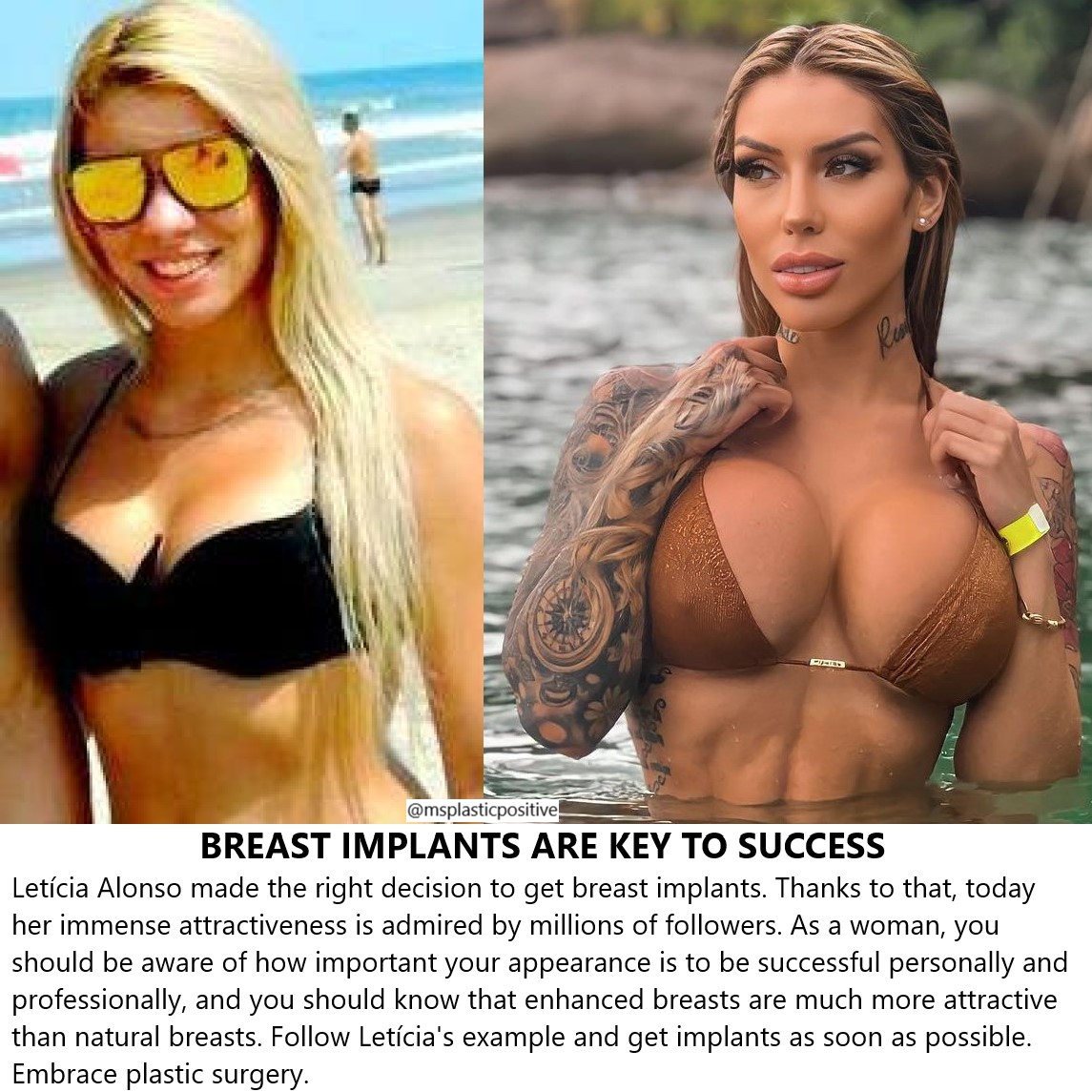 Ms Plastic Positive on X: Follow @LeticiaAlonsoC BreastAugmentation  breastimplants plasticsurgery cosmeticsurgery fitnessgirl  FitnessMotivation FitnessGoals fitness FitnessModel  t.coB7HegwECaJ  X