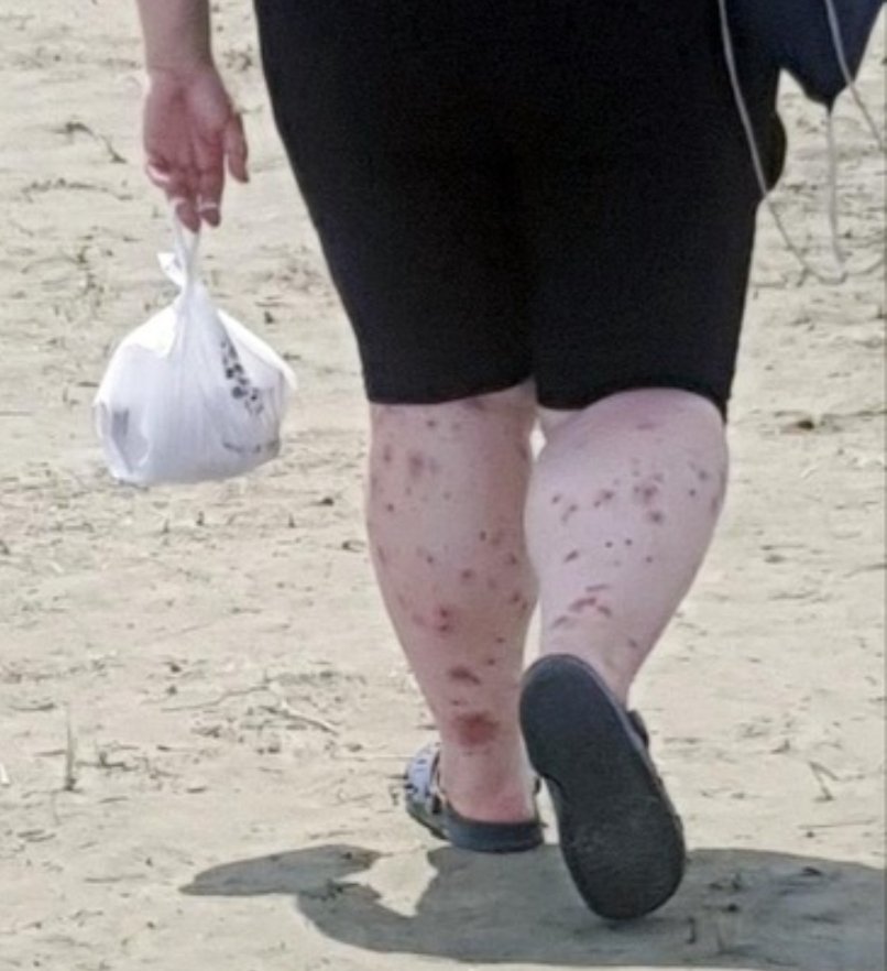 모기에 물린 잼버리 참가자 다리 모습이 처참하다. 서해안 간척지인 새만금엔 청바지도 뚫는 모기 중에서도 최악 독종인 깔다구 집중서식지란 것을 몰랐을리도 없을텐데 이게 뭐냐? 내가 부모라도 무조건 국제 손배소 하겠다.