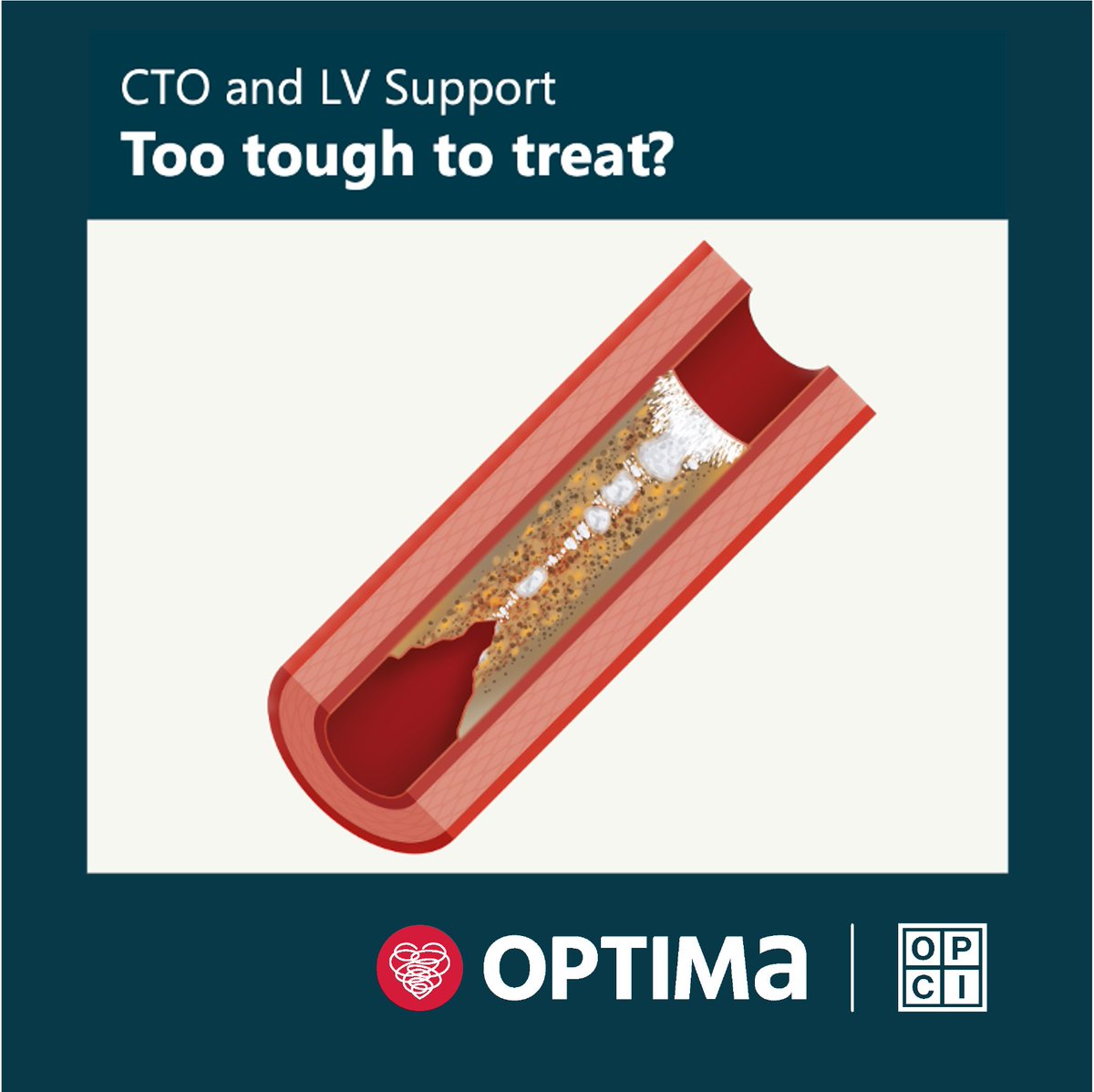 OptimaCTO's tweet photo. #Optimalpcilondon exploring the role of left ventricular support in treating complex coronary artery disease, where it may mitigate risk and in which patient subsets.
Registration is open join now ➡ https://t.co/Wari5drQvW
#optimaskills #opcilive #whyhowtry #cardiology https://t.co/ilDonQed7J