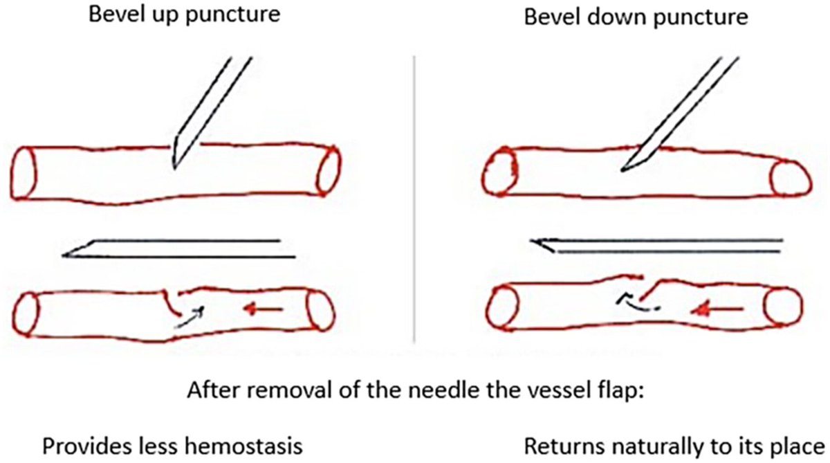M_Elraggal's tweet image. Does the #AVF needle bevel direction affect the compression time needed to close the fistula after #hemodialysis?