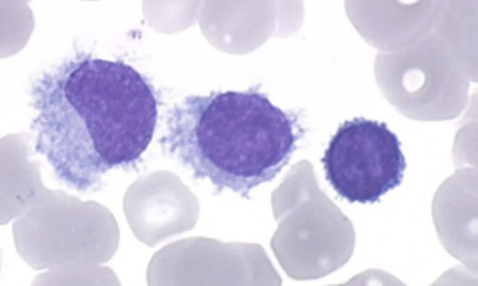 Mature B-cell Leukemias by CD5/CD10!

CD5+/CD10-:
CLL = CD23+
Leukemic mantle = CD23-, FMC7+

CD5-/CD10-: 
Hairy cell leukemia = CD123+, BRAF+ 
Hairy cell leukemia variant (now called SBLPN) = CD123-,BRAF- 
SMZL
LPL
B-cell PLL = CD5+/-, TP53

CD5-/CD10+:
Leukemic follicular cell