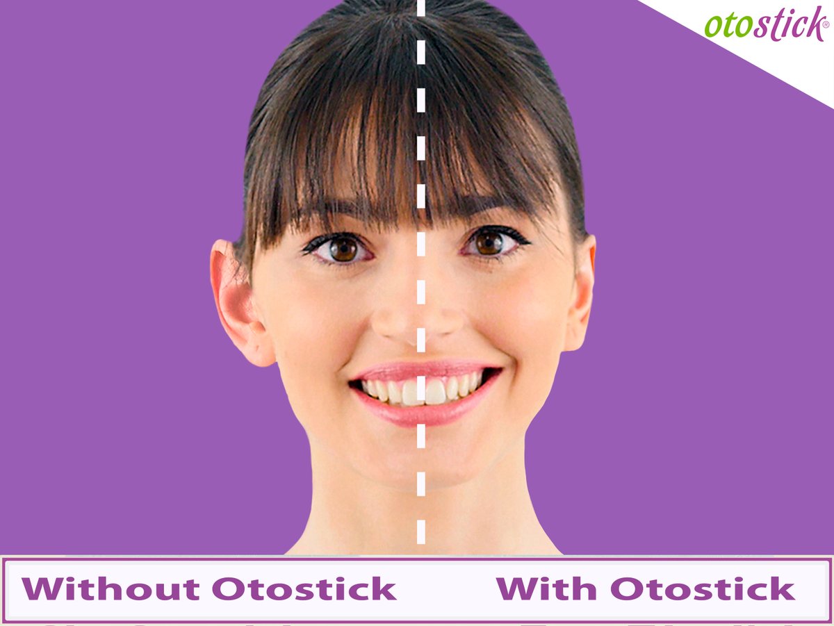 Seeking an easy fix for protruding ears? 
Introducing #Otostick, your practical, quick, and effective solution! 🙌
Achieve an immediate aesthetic effect in just a few minutes.

otostick.com

#Otostick #correctors #ears #cosmetics #earcorrector #protrudingears