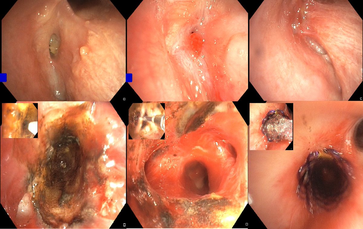 Nikolaus Kneidinger (@nikknei) on Twitter photo <a href="/GottliebJens/">Jens GOTTLIEB ⭐</a> LTX recipient from this week. Top row: natural history of a complete vanishing airway. Bottom row: reopening with Nd:YAG laser, ballon dilatation and implantation of a biodegradable 20x8mm stent. 🫁 <a href="/GottliebJens/">Jens GOTTLIEB ⭐</a> LTX recipient from this week. Top row: natural history of a complete vanishing airway. Bottom row: reopening with Nd:YAG laser, ballon dilatation and implantation of a biodegradable 20x8mm stent. 🫁
