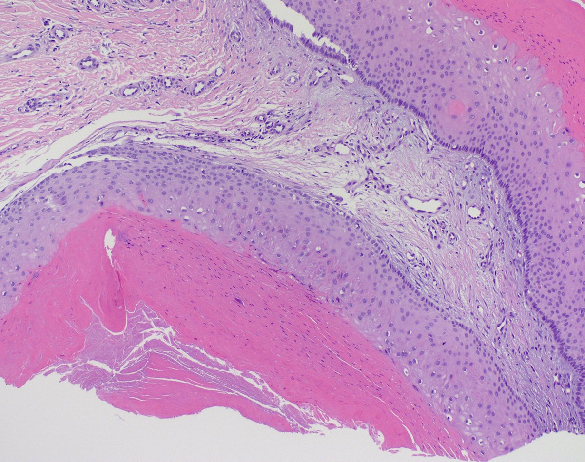 60s popliteal fossa, RO wart.
What would you call this...pilar cyst? ty!🙏
#dermpath <a href="/mccalmo/">Tim McCalmont</a> <a href="/HENRYY_MD/">Henry YANG</a> <a href="/DiegoMoralesN/">Diego Morales, MD</a> <a href="/FrozenSections/">Anurag Sharma</a> <a href="/ChristineJKoMD/">Christine J. Ko, MD</a> @ArjunRamaiya1 <a href="/et565/">Etan Marks, DO</a> @Vollkorntutgut <a href="/vincenzopolizz7/">vincenzopolizzi</a> <a href="/MarcelaSaebL/">Marcelasaeblima.</a> <a href="/JamesSampson123/">James Sampson</a> <a href="/TristanRutland7/">Tristan Rutland MBBS FRCPA IFCAP</a> <a href="/DanGrahamMD/">Dan Graham</a> <a href="/VHNguyenMD/">Van-Hung Nguyen MD 🇺🇦🌻</a>