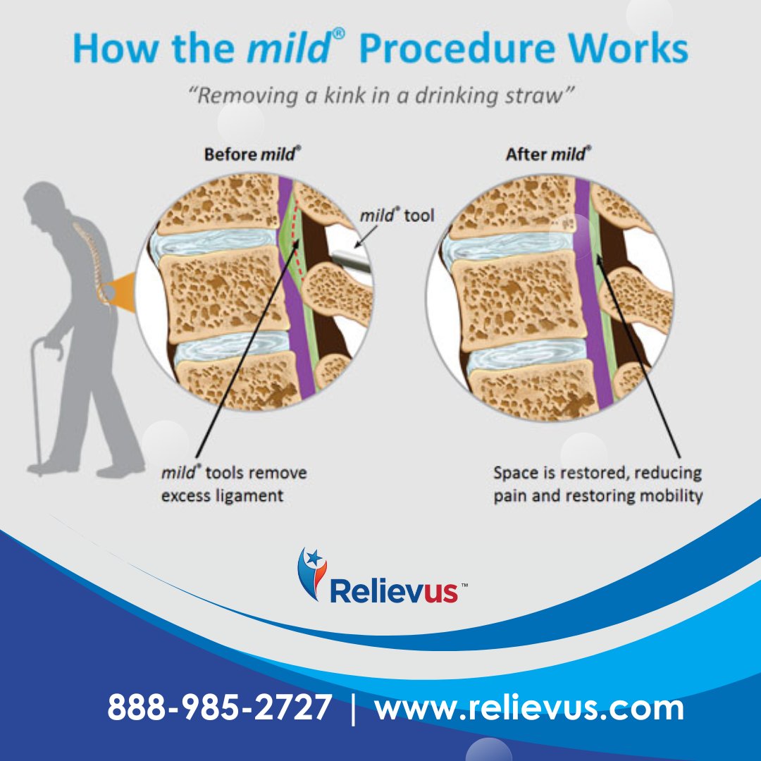 Relievus's tweet photo. Efficient.
Effective.
Respected.
Discover why leading interventionalists offer mild® to treat Lumbar Spinal Stenosis (LSS)
https://t.co/ccSwWCeQl3
https://t.co/MSVd6q9ztm
888-985-2727(ASAP)
#mildprocedure #lumbarspinalstenosis #relievus #painmanagement https://t.co/aAG5QDuXSW