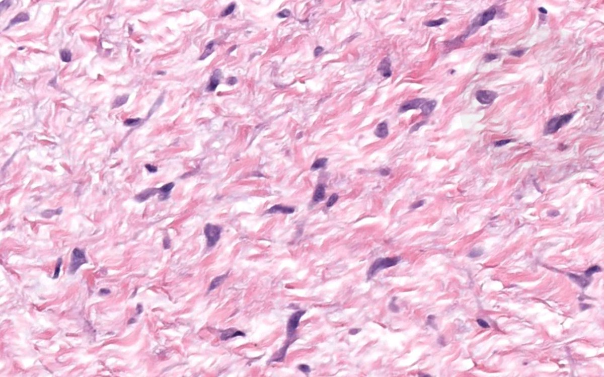 50 yo man. nodule in forearm. Can you figure out from one pic, or is it too close to diagnose? 
WSI digital slide: kikoxp.com/posts/8209
Answer &amp; video: kikoxp.com/posts/8207
#BSTpath #pathology #pathologists #pathTwitter #dermpath #dermatology #dermatologia #dermtwitter