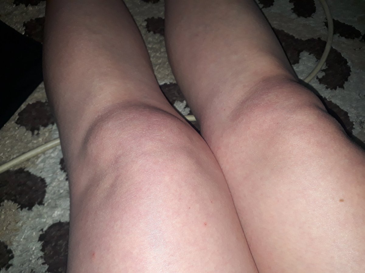 Bugün doktora gittim bacağımda bir buçuk yumruk boyunda şişkinlik var, topallamaya başladım 2, 5 yıldır. MRda birşey yok diyor hekim. Fotoğraf bile söylerken MRda sıkıntı yokmuş. Benim MRlarda niçin sürekli sıkıntı oluyor, niçin tanı konulamıyor❓
<a href="/drfahrettinkoca/">Dr. Fahrettin Koca</a> <a href="/sagliklicozum/">T.C. Sağlık Bakanlığı Sağlıklı Çözüm</a>