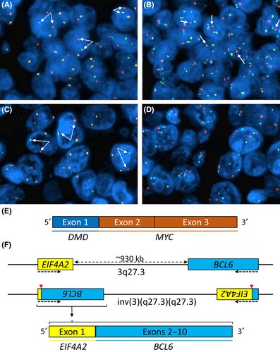 BrJHaem's tweet image. Unexpected MYC::DMD translocation after transformation of follicular lymphoma with IGH::BCL2 and IGH::MYC

onlinelibrary.wiley.com/doi/10.1111/bj… #lymsm