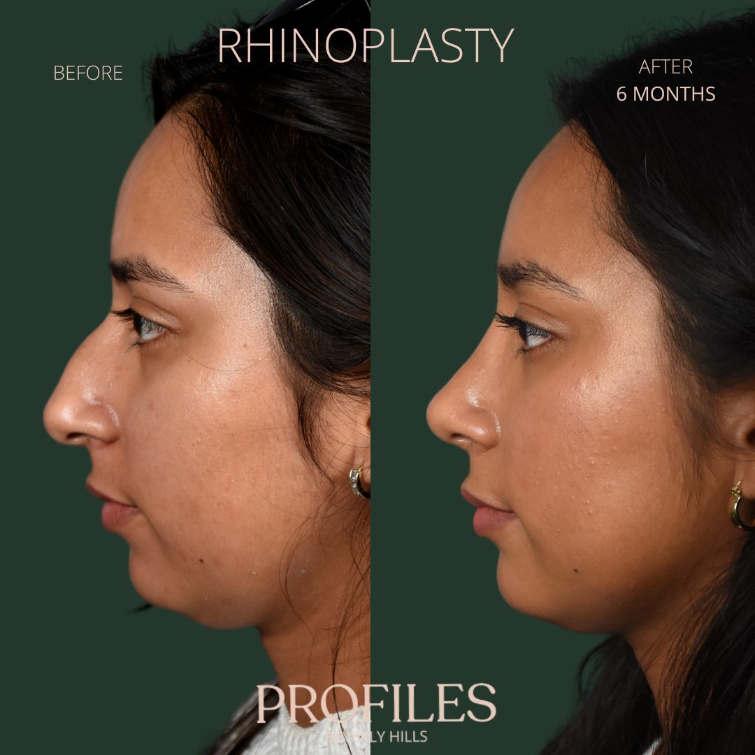 FacialPlastics's tweet photo. 📞310-276-6800
🏠 435 N Bedford Drive, PH500, Beverly Hills, 90210
👃Rhinoplasty
🗓 Before and After 6 Months
🛏 About 1 week, the cast gets taken off after 6 days

Swipe ⏩⏩⏩ for more views

Call or DM us to schedule your consultation

We also offer virtual co... https://t.co/xObQ8vGFYm