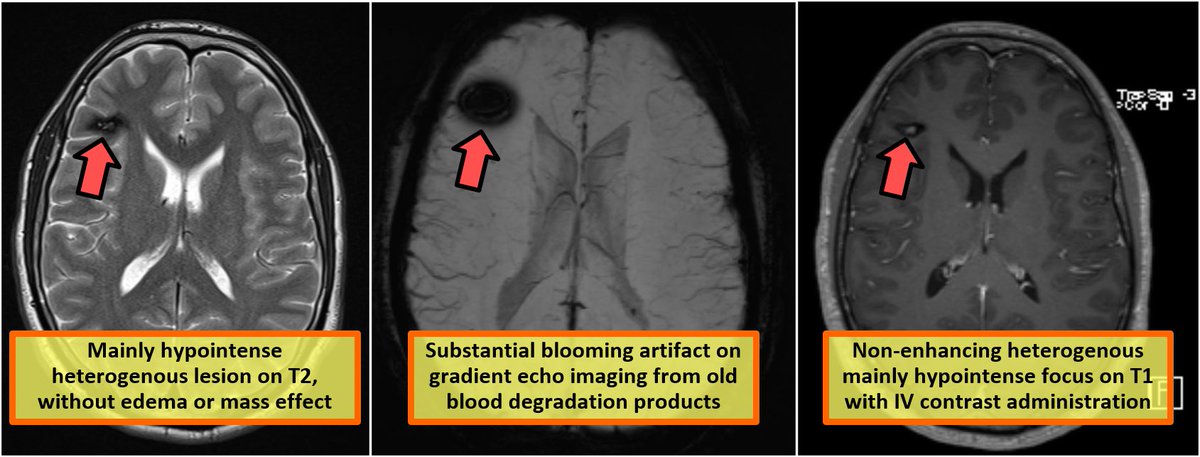 Answer Quiz243: Cavernoma

#meded #mededucation #radiology #radres #FOAMed #FOAMrad