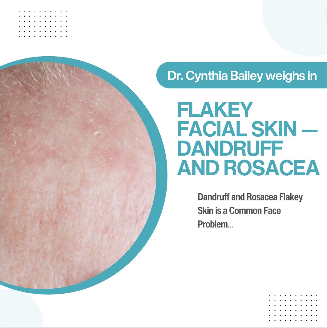Do you have flaky facial skin? Dandruff? Rosacea? 

Get the treatments for facial dandruff and the best skin care products for rosacea from board certified dermatologist Dr. Cynthia Bailey. drbaileyskincare.com/blogs/blog/bes…

#flakeyskin #dryskin #seborrheicdermatitis #rosacea