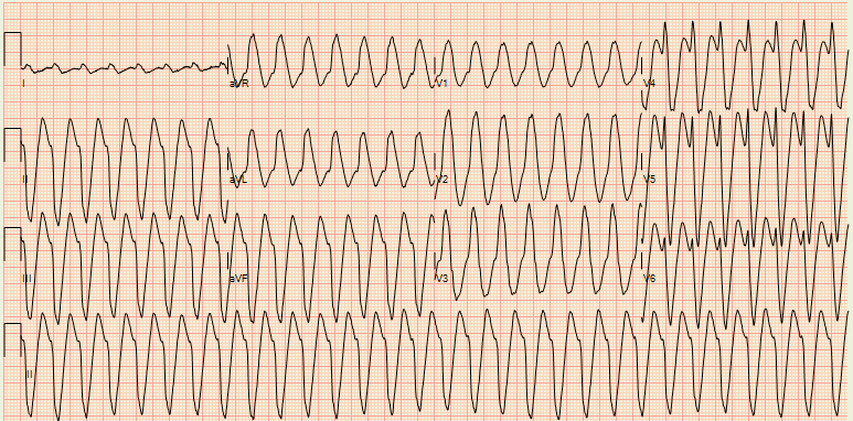 Basalus's tweet photo. 50 y/o male , ischemic CMP , ICD. Wide complex tachycardia #ECG . https://t.co/yuVcQPPrdE