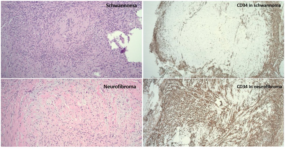 Hybrid schwannoma/neurofibroma with plexiform growth pattern. 
schwannoma ▶️CD34 negative (only subcapsular staining) 
neurofibroma ▶️Cd34 positive (lattice pattern)
#PathTwitter #BSTPath #pathteaching