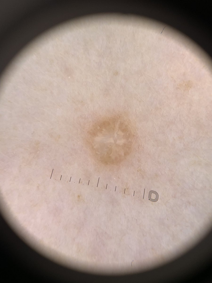 JoyNaba's tweet photo. Dermatofibroma:

- usually presents as a solitary firm papule or nodule on a limb.

- Dermoscopy: central white area surrounded by a faint pigment network. https://t.co/IqkhoKIow5