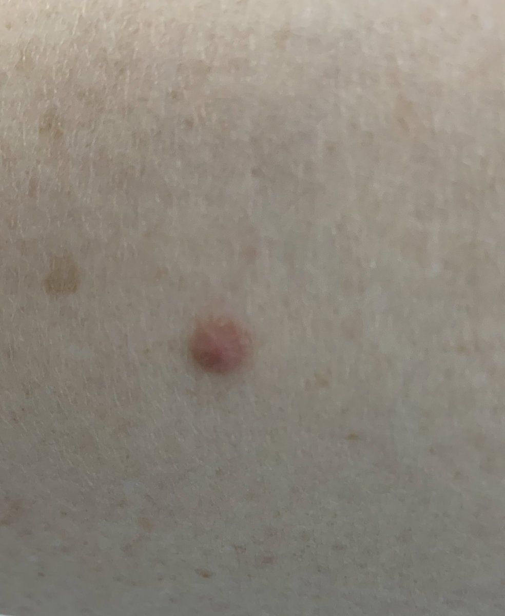 JoyNaba's tweet photo. Dermatofibroma:

- usually presents as a solitary firm papule or nodule on a limb.

- Dermoscopy: central white area surrounded by a faint pigment network. https://t.co/IqkhoKIow5