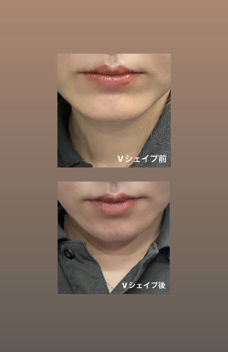 痩せた？ってやたら言われるんだけど多分顎のおかげな気がする、、🥺
もうすぐ術後3ヶ月くらいだけど
久しぶりにビフォアフ撮ったら形変わってるわぁ🥲♡