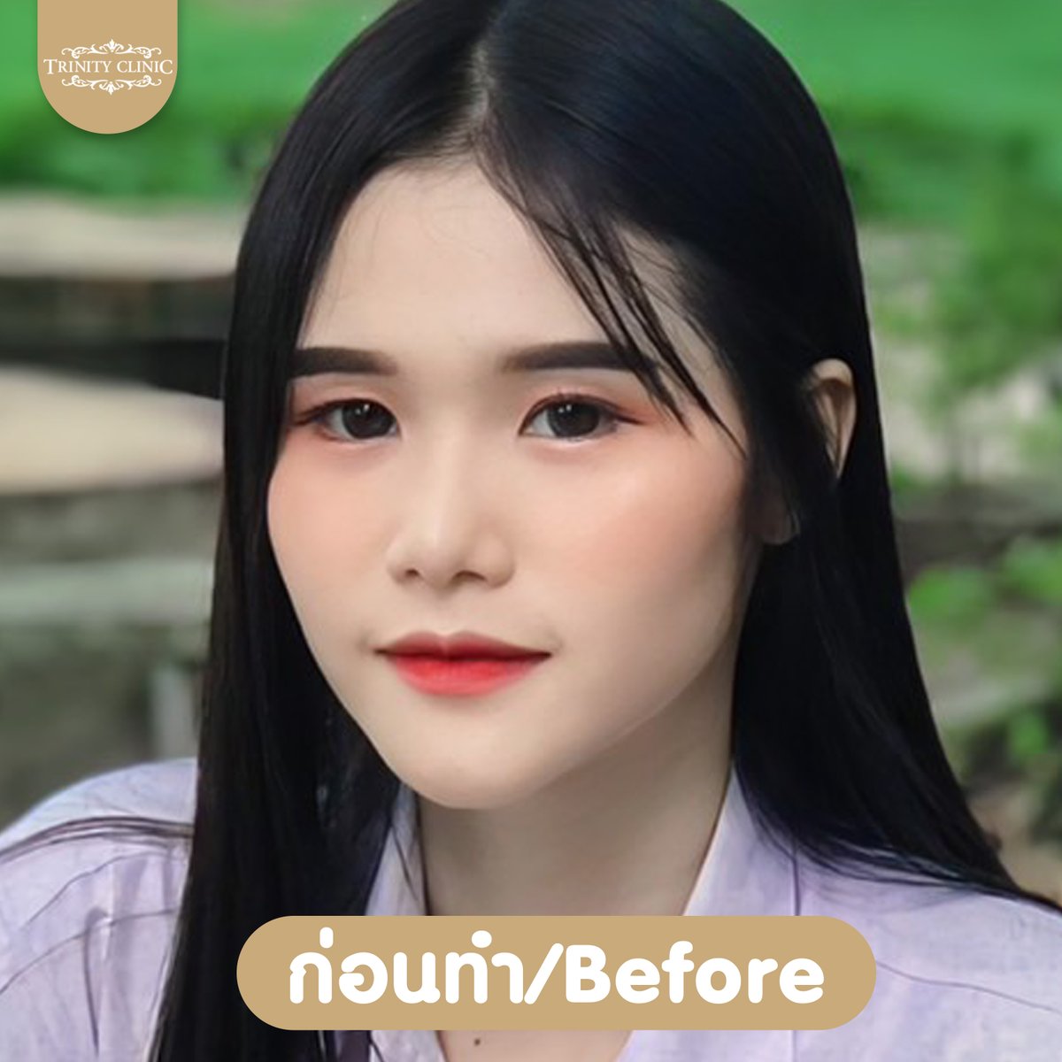 trinityclinic01's tweet photo. หน้าเปลี่ยนมาก ความเป๊ะยืนหนึ่ง
ทรงคือสวยมาก น้องทิพย์ จมูกสวยปัง
สอบถามเพิ่มเติม 095-5150547
https://t.co/ZOoqKMZwfR
#เสริมจมูก #ศัลยกรรมสวย #NTLT #ทรินิตี้คลินิก #รีวิวบิวตี้ #เน็ตไอดอล #ศัลยกรรม #รีวิวศัลยกรรม #botox #ฟิลเลอร์ #HIFU #หน้าตึง #beauty #TwitterX https://t.co/vxr36vb05P